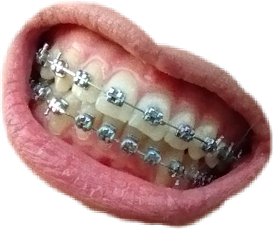 braces teeth lips freetoedit #braces sticker by @galacticsky