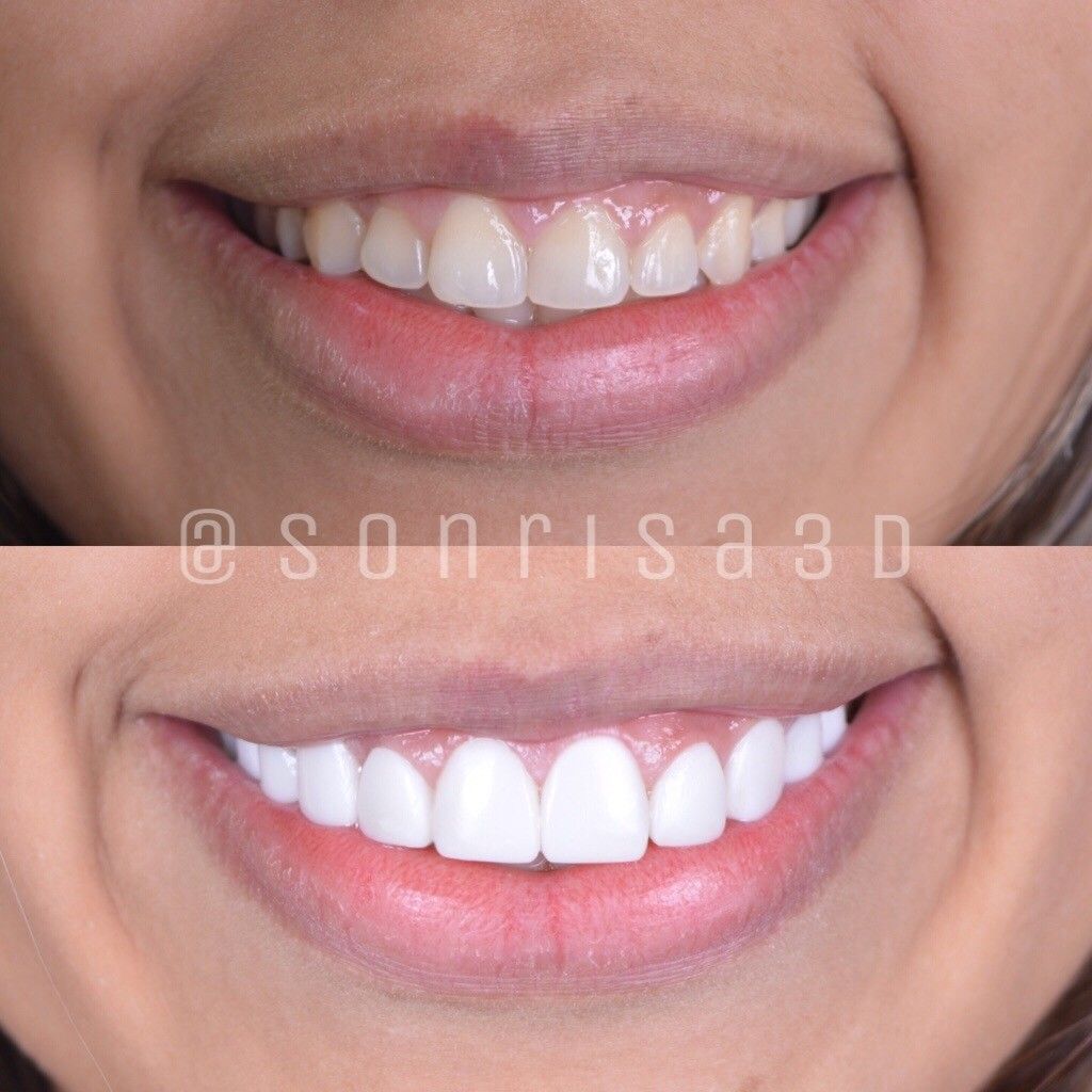 Dental clareamento