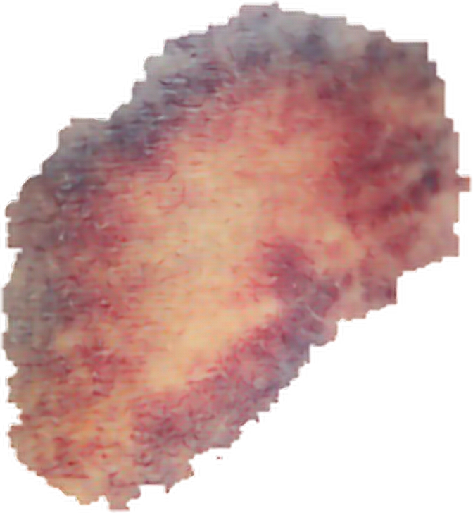 Bruise Png Transparent Png Transparency Creator Examp vrogue.co